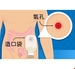 大腸造口灌洗法