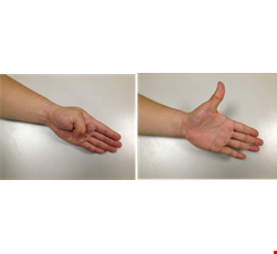 Introduction to Trigger Finger 媽媽手居家保健運動