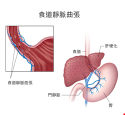 食道靜脈曲張及出血