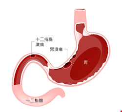 消化性潰瘍及出血