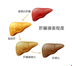 肝硬化診斷與治療
