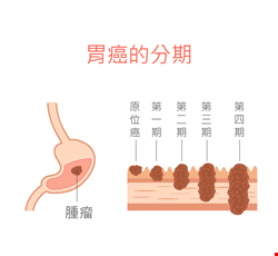 胃癌的早期症狀