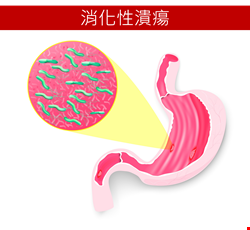 胃幽門螺旋桿菌診斷及治療