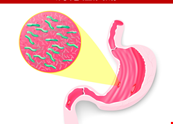 胃幽門螺旋桿菌診斷及治療