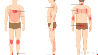 Prevention and Treatment for Pressure Injury 壓力性損傷的預防與治療