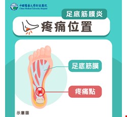 足底筋膜炎