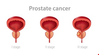 Prostate-Specific Antigen Interpretation 攝護腺特定抗原PSA判斷說