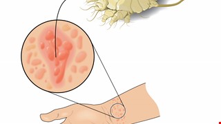 Prevention and Treatment of Scabies 疥瘡的預防與治療