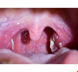 Tonsillitis 扁桃腺炎