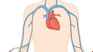 Health Education Instructions After Hickman Catheter or Central Venous Catheter Insertion Hickman希克曼氏導管、CVC中央靜脈導管、PICC周邊置入式中央靜脈導管術後衛教說明