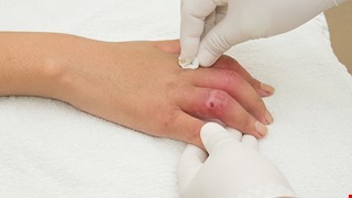 Emergency-How to use artificial skin 急診—人工皮使用方法