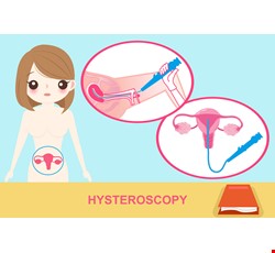 Hysteroscope examination 子宮鏡檢查