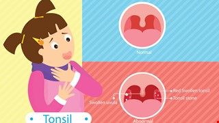 Acute Tonsilliti 兒童扁桃腺炎