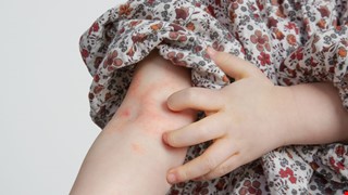 Daily Care for Atopic Dermatitis 異位性皮膚炎日常保養
