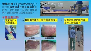 燒傷水療治療的目的與臨床效益/BURN