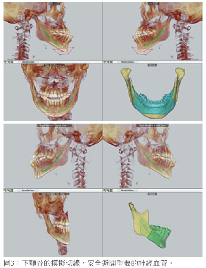 圖3：下顎骨的模擬切線，安全避開重要的神經血管。