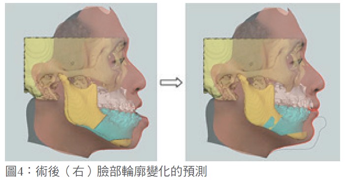 圖4：術後（右）臉部輪廓變化的預測