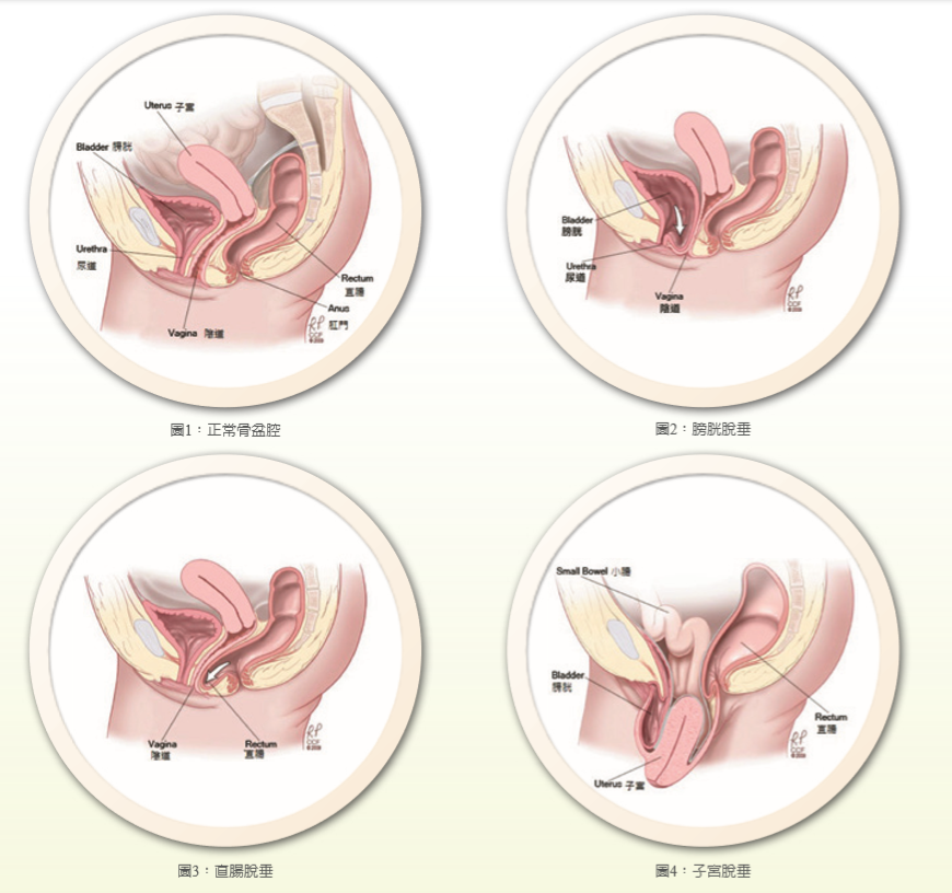 圖1：正常骨盆腔 圖2：膀胱脫垂 圖 3：直腸脫垂 圖4：子宮脫垂