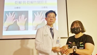 Be careful! Poor psoriasis control can also lead to deformed joints