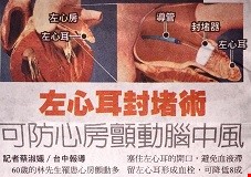 左心耳封堵術  可防心房顫動腦中風
