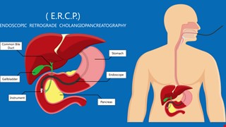 經內視鏡逆行性膽胰管攝影檢查術