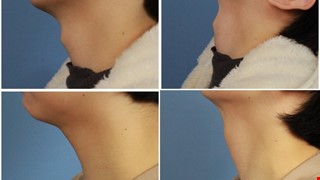 喉結手術、無疤痕喉結減積手術 （Scarless Thyroid Cartilage Reduction）