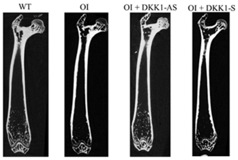 Dickkopf-1 (DKK1) blockade mitigates osteogenesis imperfecta (OI) related bone disease img