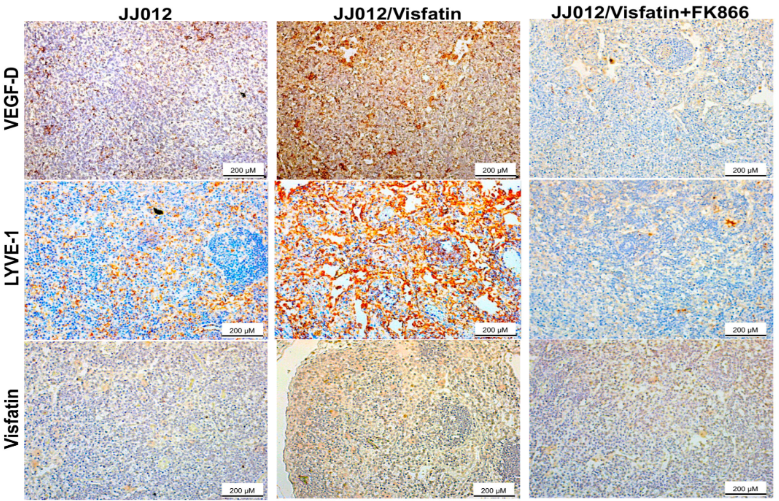 Visfatin Facilitates VEGF-D-Induced Lymphangiogenesis through Activating HIF-1α and Suppressing miR-2277-3p in Human Chondrosarcoma img