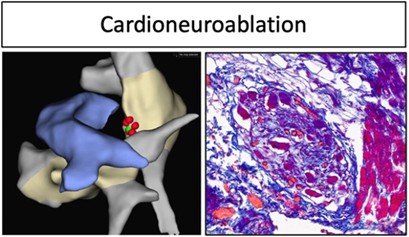 Ischemia-induced ventricular proarrhythmia and cardiovascular autonomic dysreflexia after cardioneuroablation img